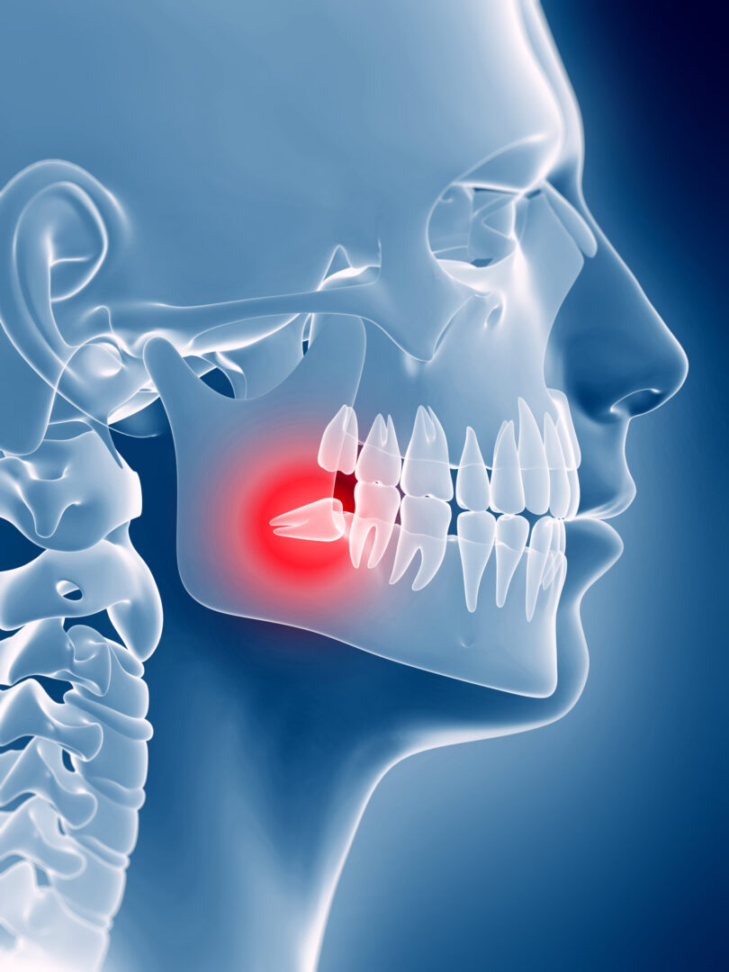 Wisdom Teeth Removal